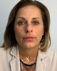 Dott.ssa Sara Carinci Filler labbra