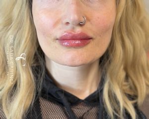Dott.ssa Sara Carinci Filler Labbra