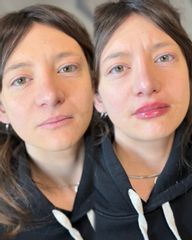 Dott.ssa Sara Carinci Filler labbra