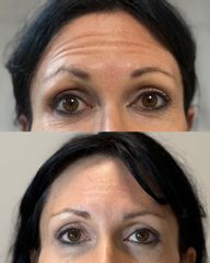 Dott.ssa Sara Carinci Botox