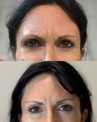 Dott.ssa Sara Carinci Botulino