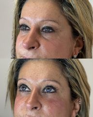 Dott.ssa Sara Carinci Filler occhiaie