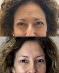 Dott.ssa Sara Carinci tossina botulinica