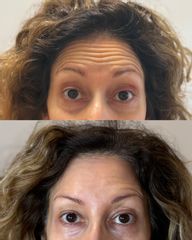 Dott.ssa Sara Carinci Botox