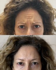 Dott.ssa Sara Carinci Botox