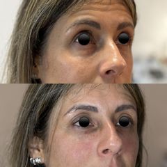 Dott.ssa Sara Carinci Filler occhiaie