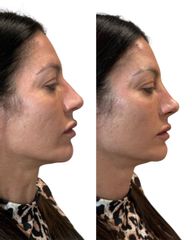 Dott.ssa Sara Carinci Rinofiller