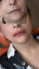 Dott.ssa Sara Carinci Filler labbra