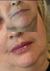 Dott.ssa Sara Carinci Lip Filler