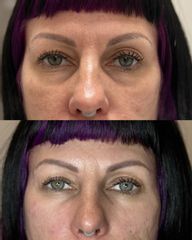 Dott.ssa Sara Carinci Filler occhiaie