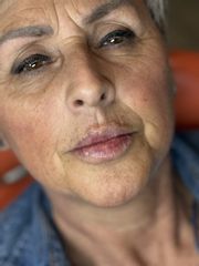 Dott.ssa Sara Carinci Filler labbra