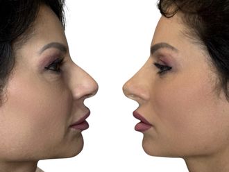 Rinofiller prima e dopo - 878735