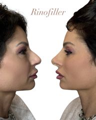 Dott.ssa Sara Carinci Rinofiller