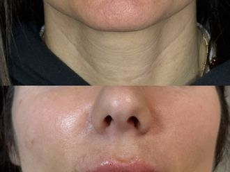 Filler labbra prima e dopo - 878852