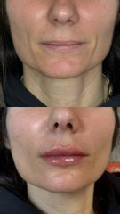 Dott.ssa Sara Carinci Filler labbra