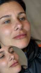 Dott.ssa Sara Carinci Filler labbra