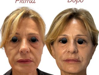 Ringiovanimento prima e dopo - 878871