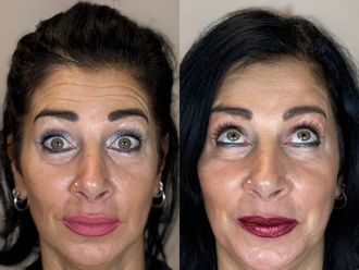 Botulino prima e dopo - 878872
