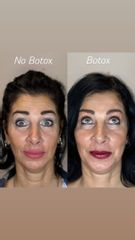 Dott.ssa Sara Carinci Botox