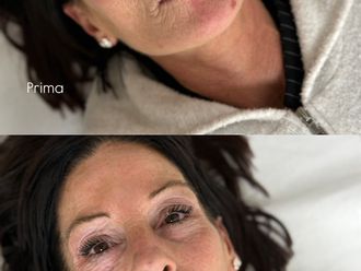 Filler labbra prima e dopo - 878938