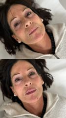 Dott.ssa Sara Carinci Filler labbra