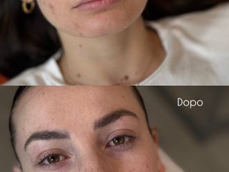 Filler labbra prima e dopo - 879194