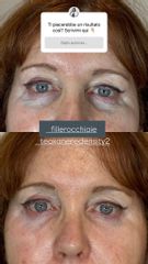Filler occhiaie