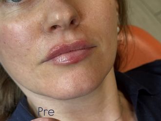 Filler labbra prima e dopo - 879196