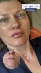 Dott.ssa Sara Carinci Filler labbra