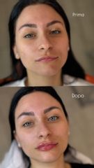 Dott.ssa Sara Carinci Filler labbra