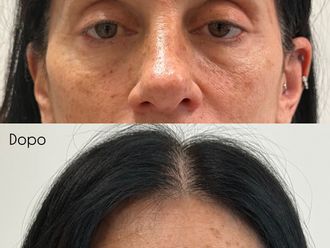 Eliminare occhiaie prima e dopo - 879248