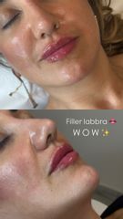 Dott.ssa Sara Carinci Filler labbra