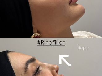 Rinofiller prima e dopo - 879718