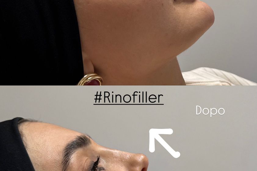 Rinofiller prima e dopo - 879718