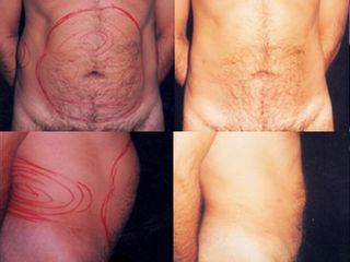 Liposuzione prima e dopo