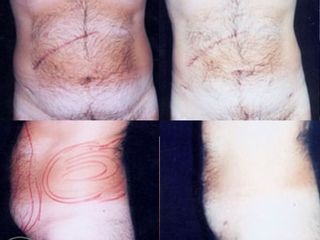 Liposuzione prima e dopo