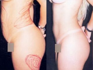 Liposuzione prima e dopo