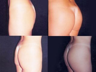 Gluteoplastica prima e dopo