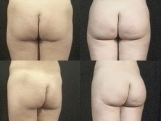 Gluteoplastica prima e dopo