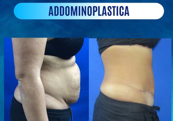 Addominoplastica prima e dopo