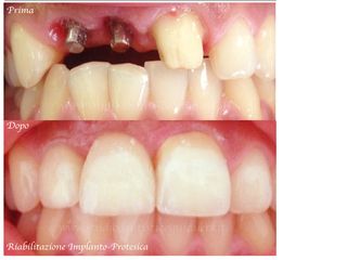 implantologia prima e dopo