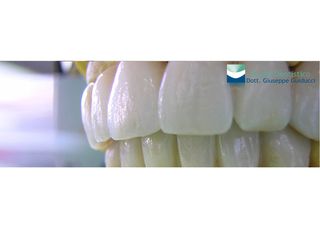 Faccette estetiche dentali