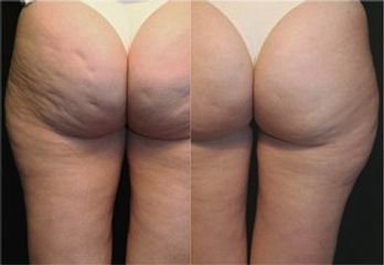 Cellulite prima e dopo