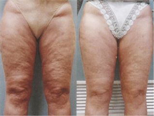 Cellulite prima e dopo