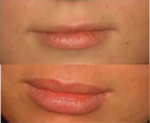 Acido Ialuronico Labbra Prima e Dopo 