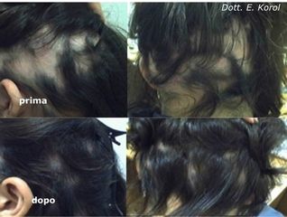 Alopecia aerata prima e dopo