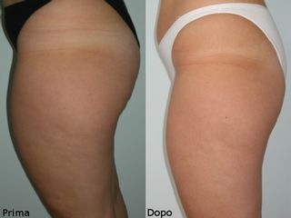 Trattamento cellulite prima e dopo