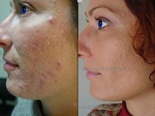 Acne prima e dopo