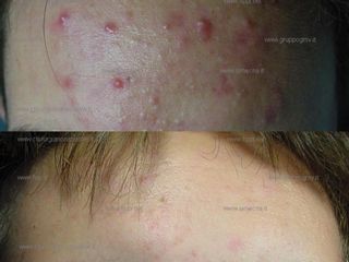Acne prima e dopo
