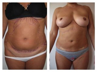 liposuzione prima dopo
